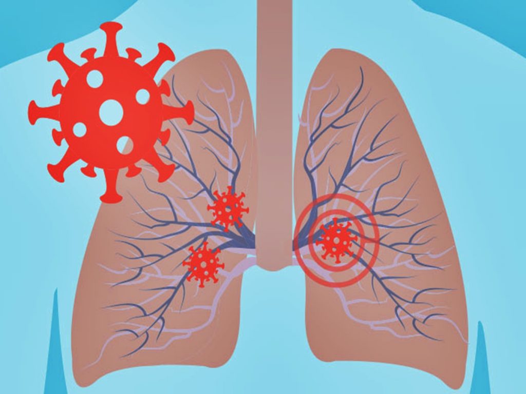 Men Are More Likely To Suffer From Lung Infections