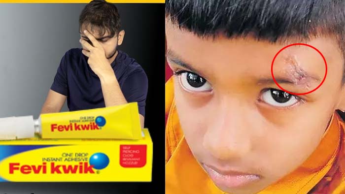 Doctors Treated With Fevikwik Instead Of Stitches In Jogulamba Gadwal District