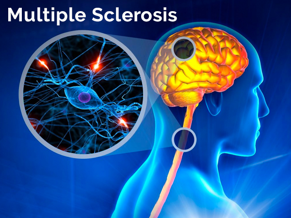 Multiple Sclerosis Causes Sympotoms