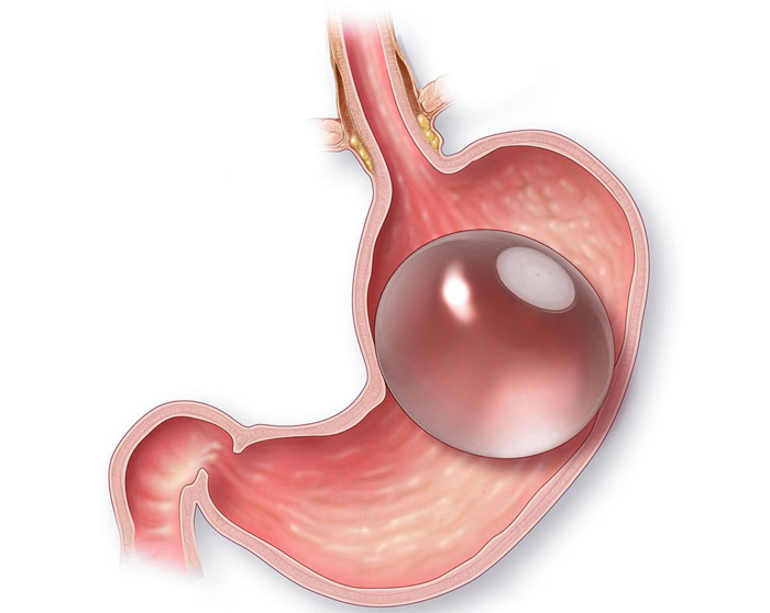 Intragastric Balloon Star Hospitals