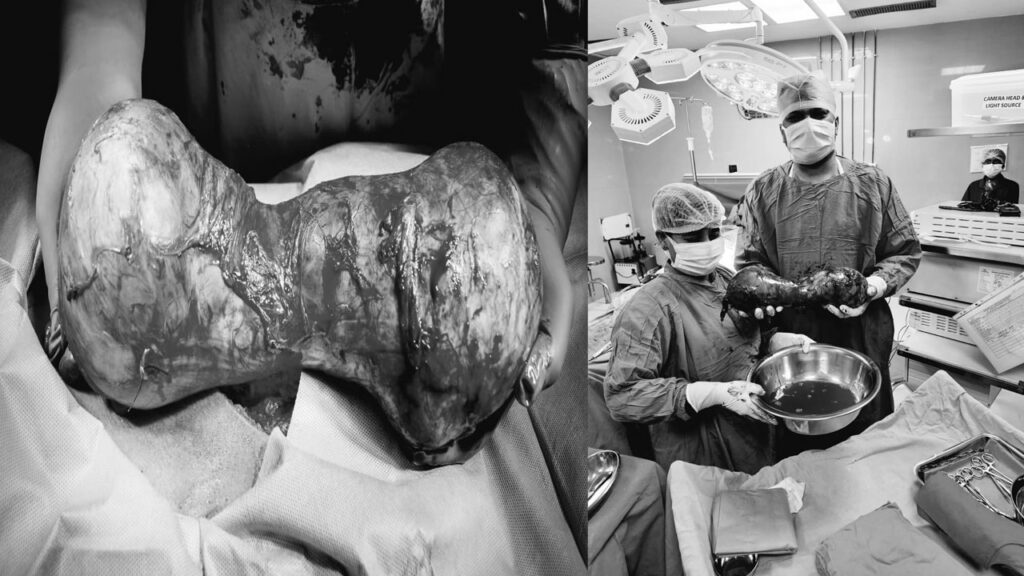 Ainu Doctors Team Remove Rare Dumbbell Shaped Giant Testis Tumor In Kidney Transplant Recipient