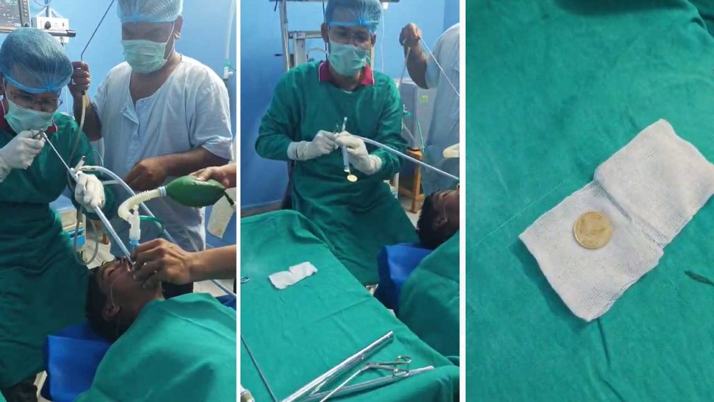 A Boy Swallowed A Five Rupee Coin In Kodisa Village Regidi Mandal Vizianagaram District