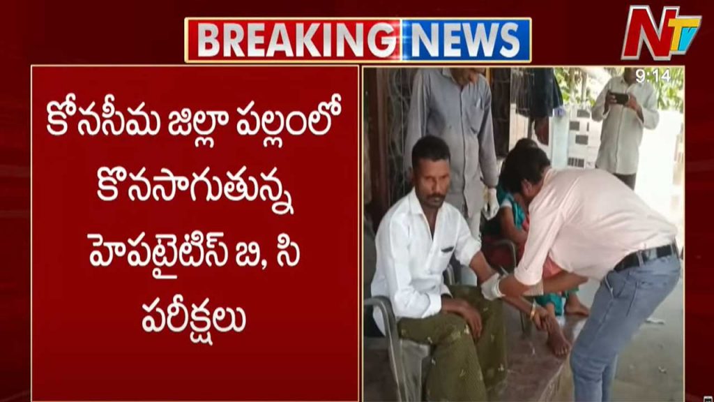 Hepatitis Tests In Konaseema District 205 People Tested Positive
