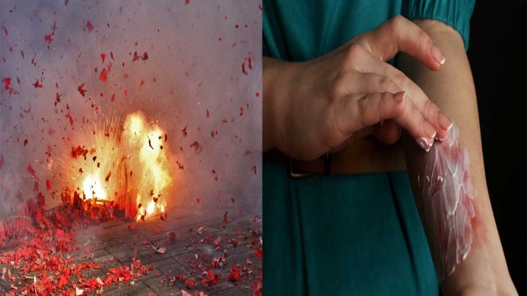 Diwali 2025 Firecracker Burn Injuries Safe Home Remedies And First Aid Tips Are