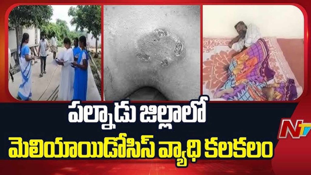 Confirmed Melioidosis Case In Daavupalli Thanda In Palnadu