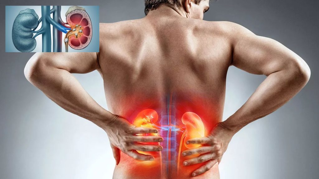 Kidney Stones Causes Symptoms And Prevention Tips Simple Habits To Protect Your Kidneys