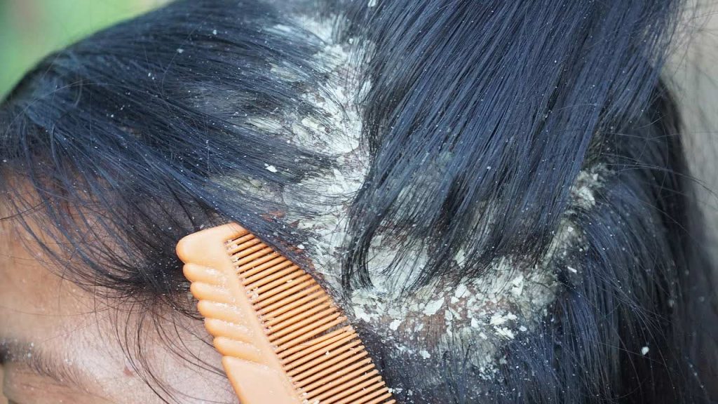 Why Dandruff Occurs Causes Home Remedies And Prevention