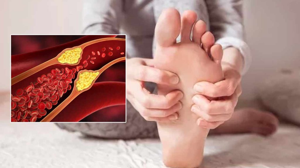 High Cholesterol Warning Signs In Your Feet Dont Ignore These Early Symptoms
