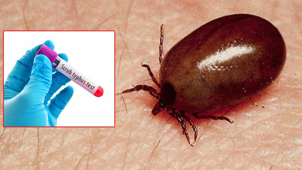 Palnadu Dmho Clarifies On Scrub Typhus 11 Cases Reported No Need For Public Panic