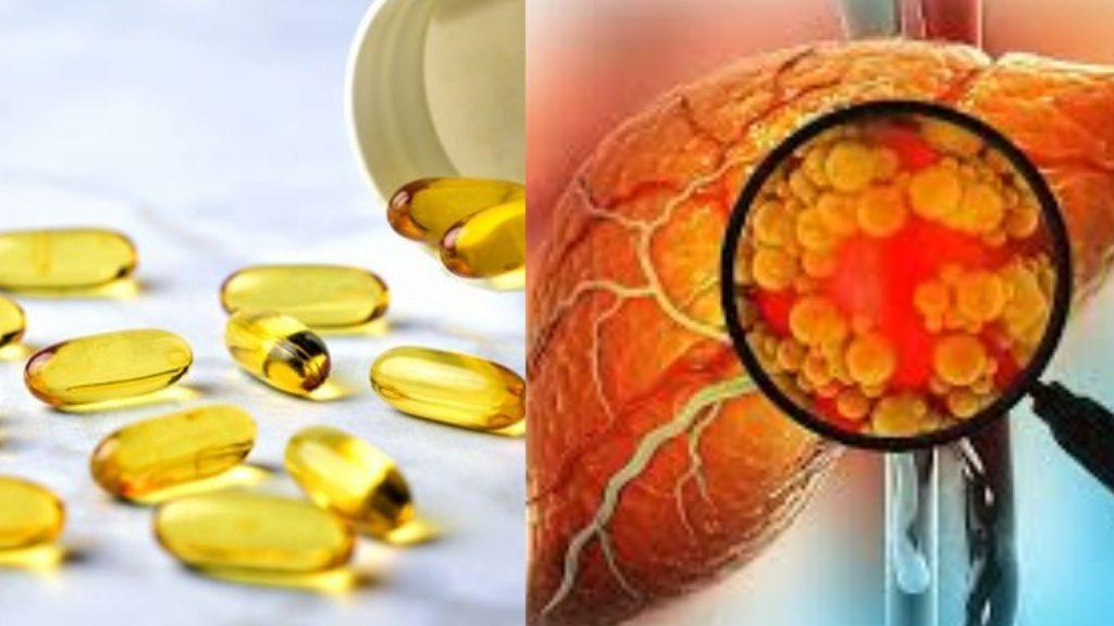 Vitamin B12 Deficiency Linked To Fatty Liver New Research Reveals Hidden Risk Factor