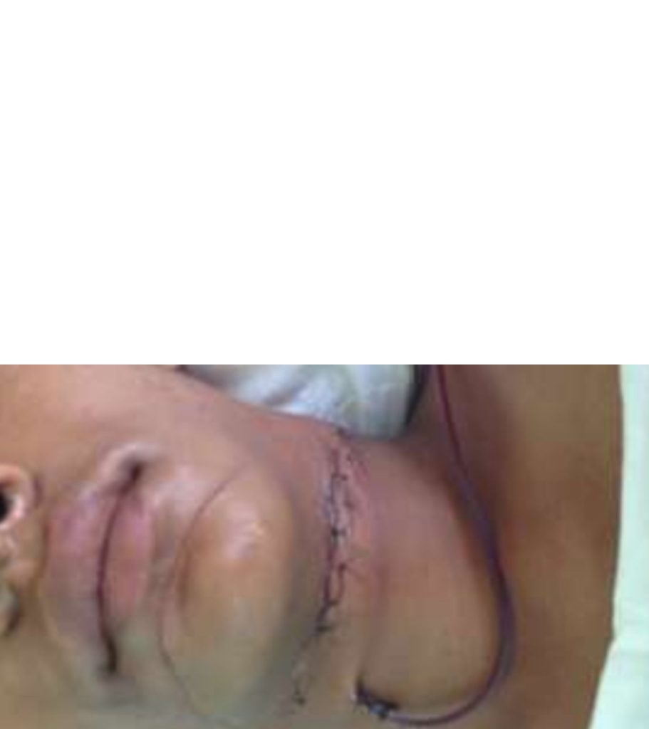 Chinese Manja Accident In Medchal Youth Suffers Severe Neck Injury 19 Stitches