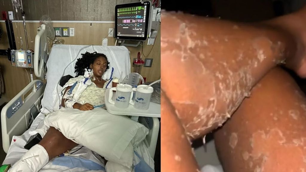 Scary Effects Of Brown Recluse Spider Bite On A Woman Hospitalized Skin Peeling