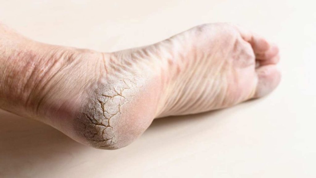 Cracked Heels Home Remedies Causes Prevention