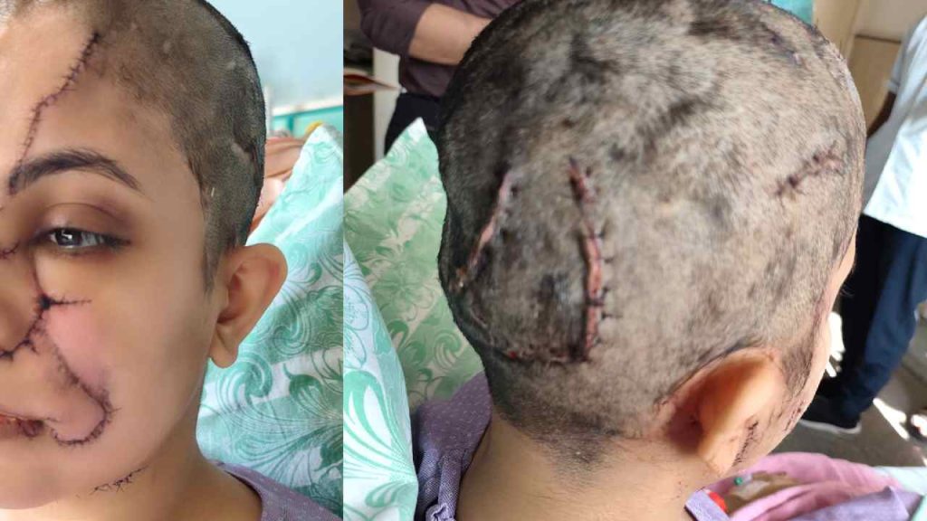 Bengaluru Woman Attacked By Pet Dog Suffers Severe Injuries And 50 Stitches