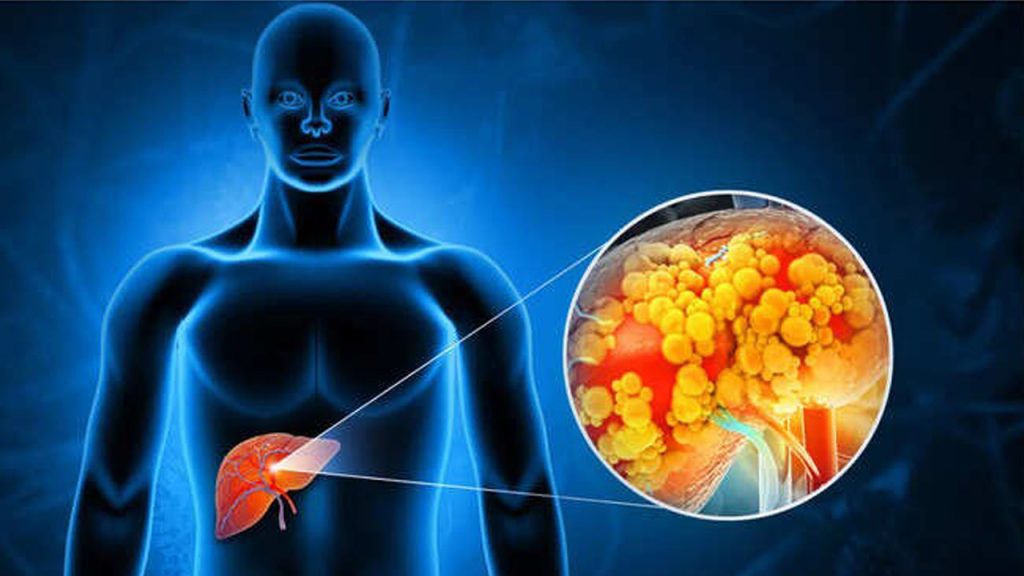 Fatty Liver Reversal Diet Exercise Natural Treatment