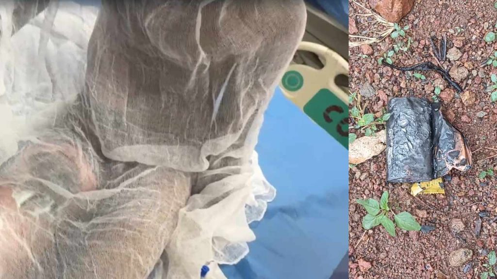 Sangareddy School Student Injured Power Bank Explosion